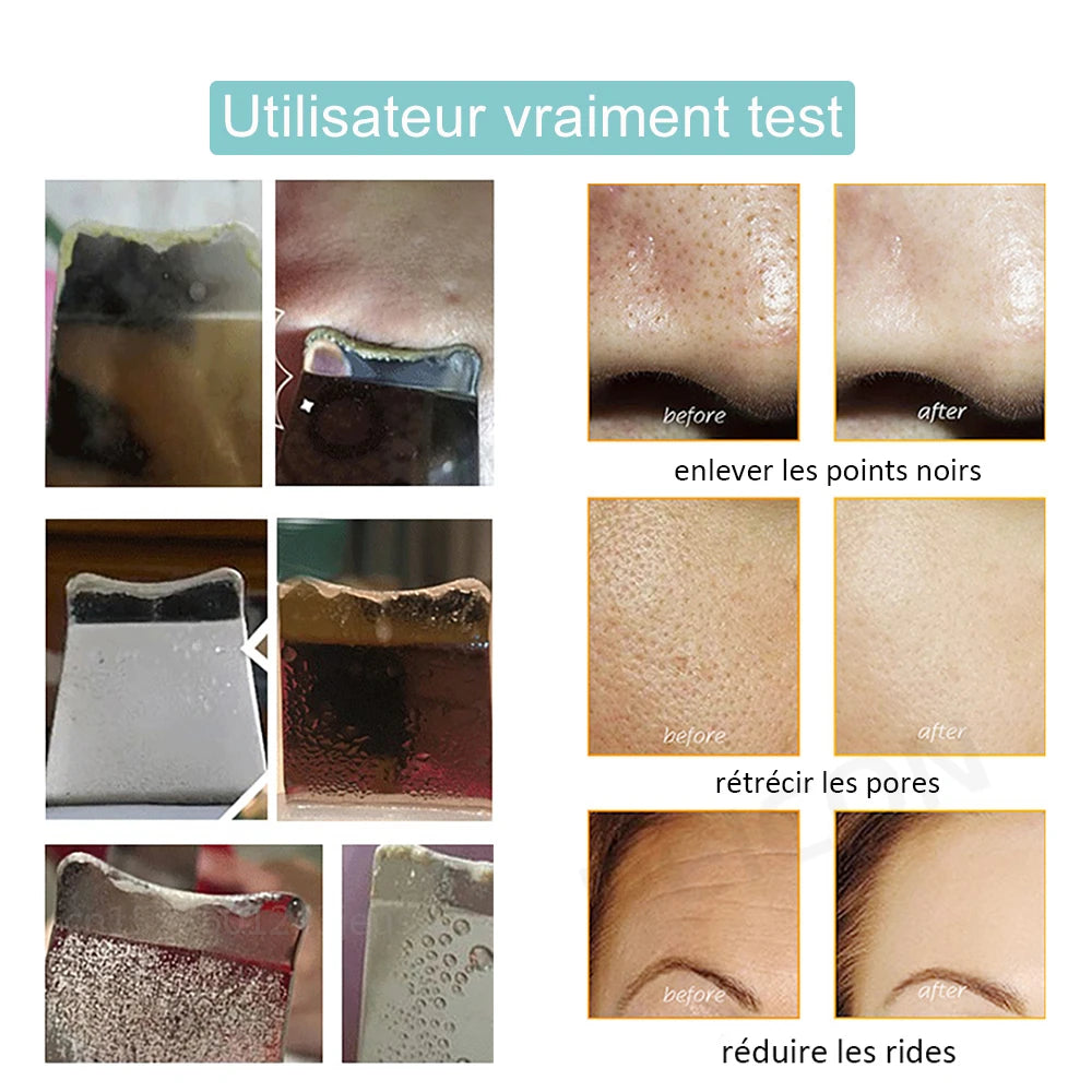 Épurateur de peau à ultrason